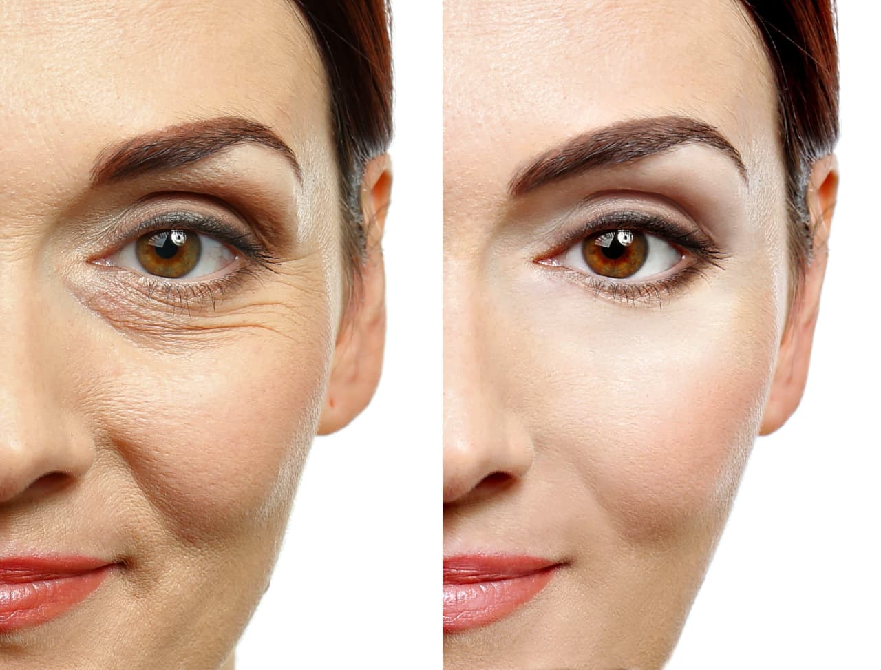 Forehead lines and wrinkle treatment Dubai