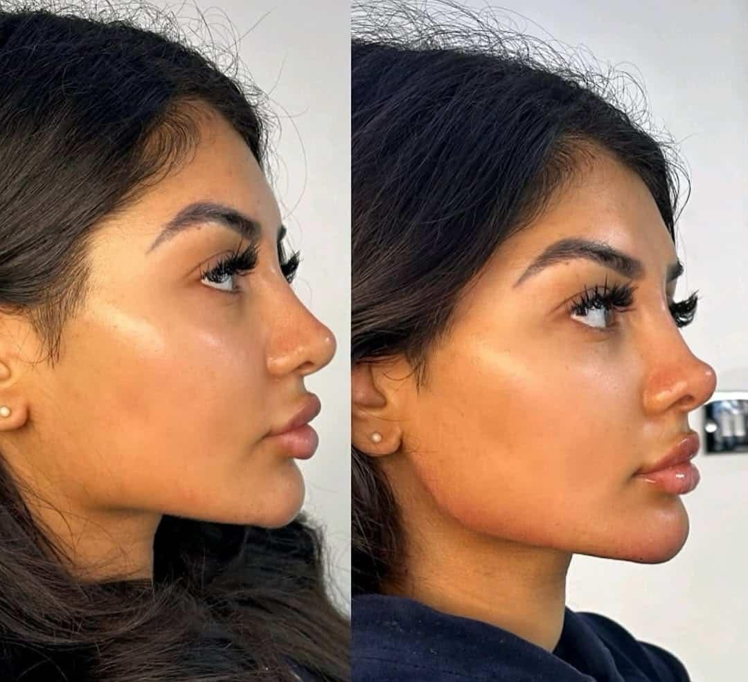 Lip and facial filler results Dubai