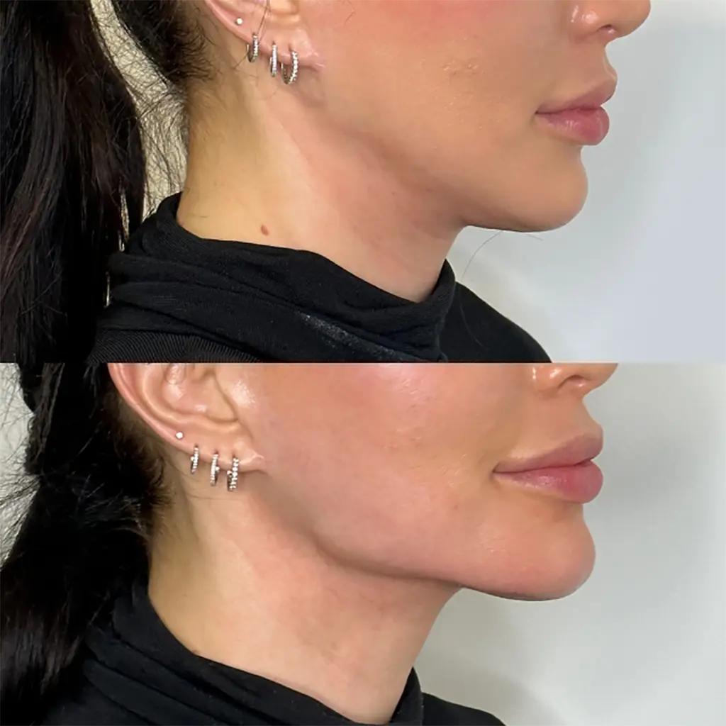 Dermal filler treatment at Beauty For Less Clinics Dubai