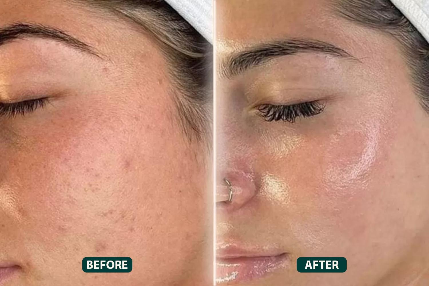 HydraFacial treatment Dubai at Beauty For Less Clinics